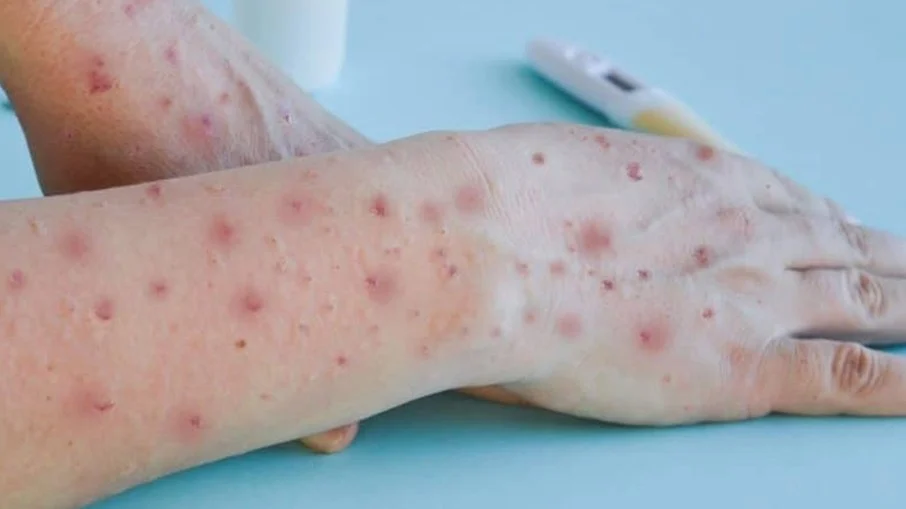 Casos de Monkeypox chegam a 128 na Região Metropolitana de Campinas