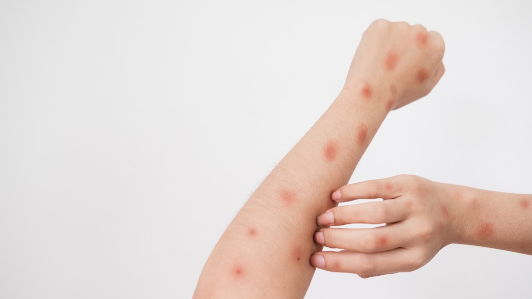 Monkeypox: Sem casos graves, Campinas completa 2 meses do 1º registro