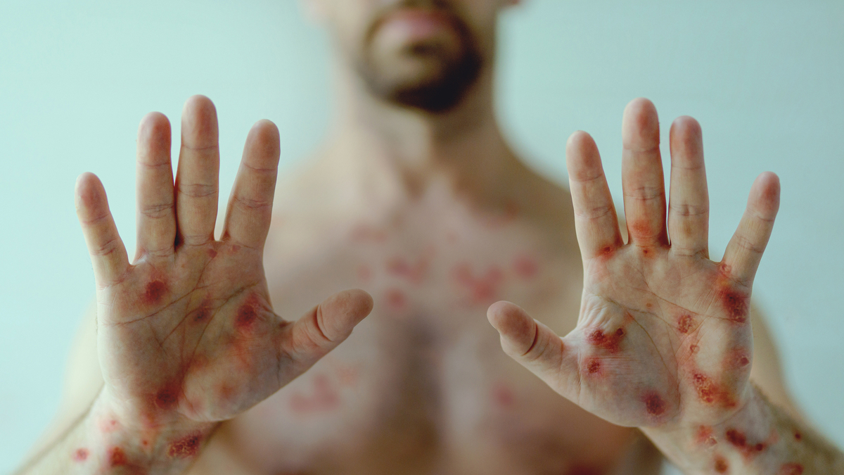 Campinas não tem previsão para vacinação contra mpox