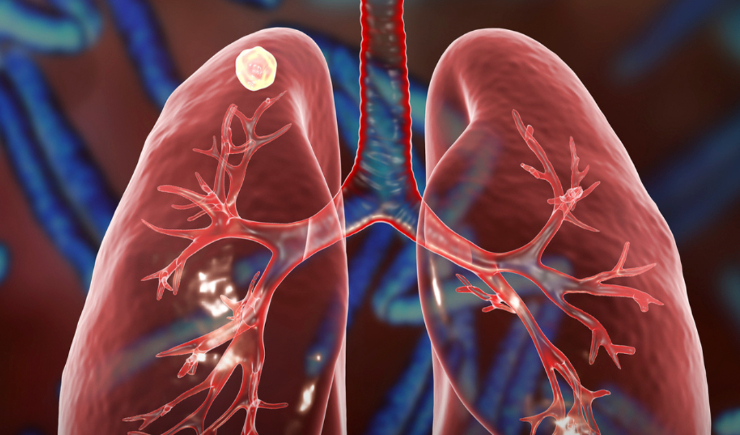SUS incorpora “pretomanida”, para tratamento de tuberculose resistente