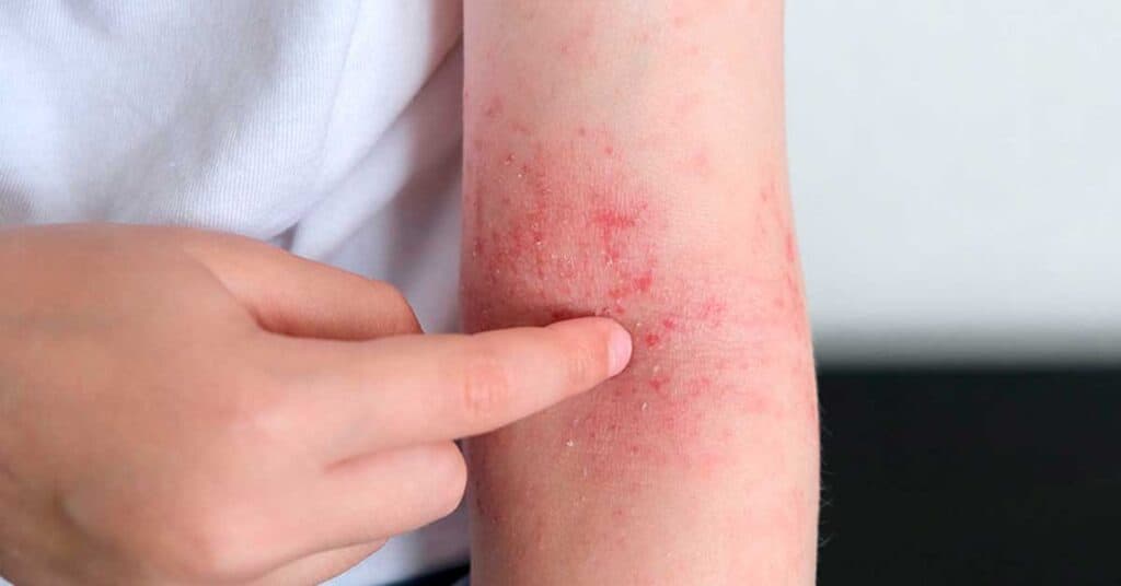 Dermatite atópica: saiba quais são os sintomas e as causas