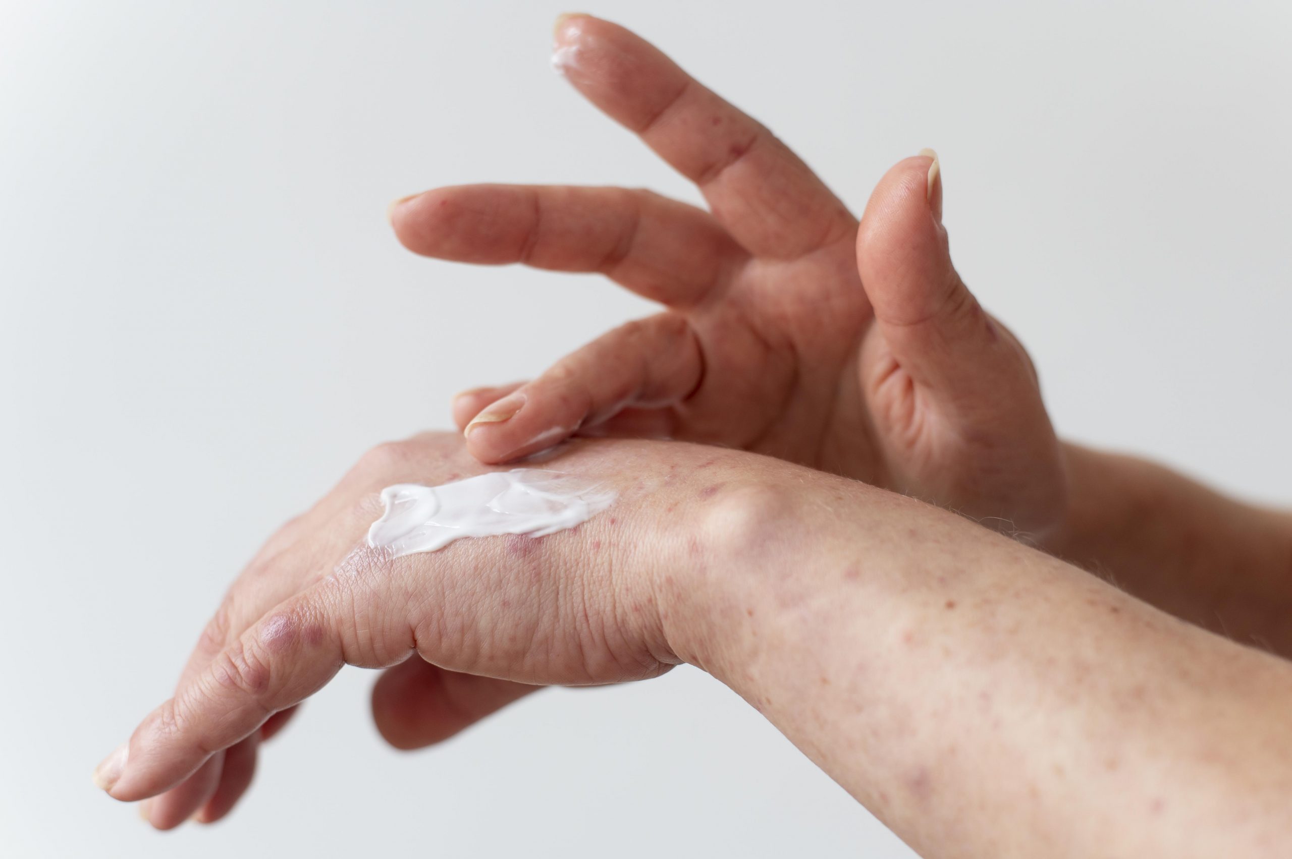 Estado de São Paulo registra aumento de 18% nos atendimentos por dermatite atópica no SUS