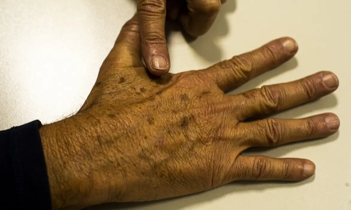 Uso de protetor solar independe da época ou fator de risco, alerta dermatologista
