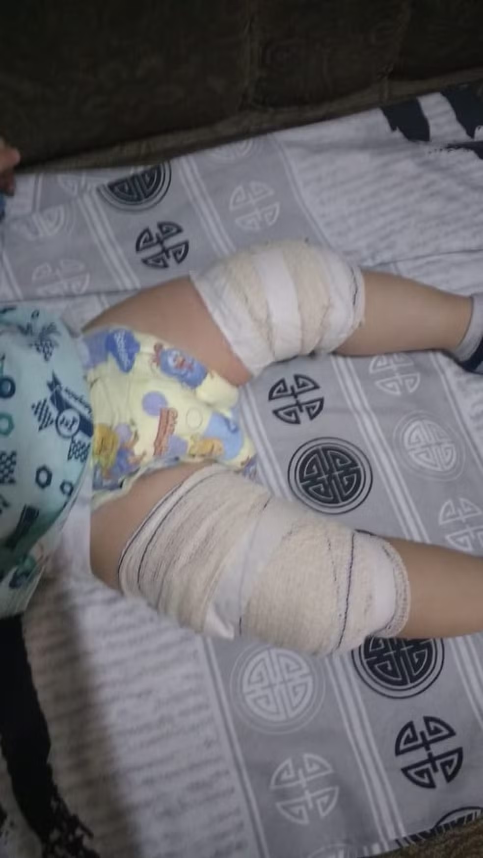 Limeira é condenada a pagar R$ 20 mil após bebê sofrer queimadura com sopa em creche
